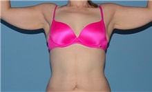 Body Contouring Before Photo by Siamak Agha, MD; Newport Beach, CA - Case 44122