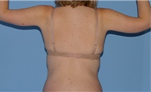 Body Contouring After Photo by Siamak Agha, MD PhD FACS; Newport Beach, CA - Case 44122