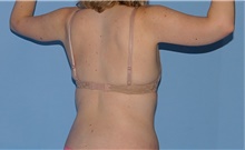 Body Contouring After Photo by Siamak Agha, MD PhD FACS; Newport Beach, CA - Case 44122