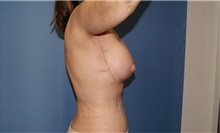 Body Contouring After Photo by Siamak Agha, MD PhD FACS; Newport Beach, CA - Case 44124