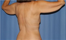 Body Contouring Before Photo by Siamak Agha, MD PhD FACS; Newport Beach, CA - Case 44124