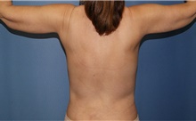 Body Contouring After Photo by Siamak Agha, MD PhD FACS; Newport Beach, CA - Case 44124