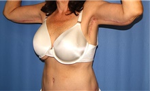 Body Contouring After Photo by Siamak Agha, MD PhD FACS; Newport Beach, CA - Case 44125