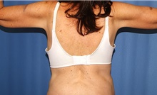 Body Contouring After Photo by Siamak Agha, MD PhD FACS; Newport Beach, CA - Case 44125