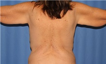 Body Contouring Before Photo by Siamak Agha, MD PhD FACS; Newport Beach, CA - Case 44125