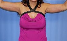 Body Contouring After Photo by Siamak Agha, MD PhD FACS; Newport Beach, CA - Case 44127