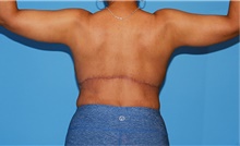 Body Contouring After Photo by Siamak Agha, MD PhD FACS; Newport Beach, CA - Case 44128