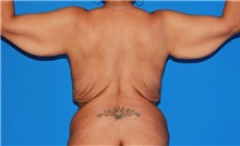 Body Contouring Before Photo by Siamak Agha, MD PhD FACS; Newport Beach, CA - Case 44128