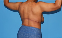 Body Contouring After Photo by Siamak Agha, MD PhD FACS; Newport Beach, CA - Case 44128