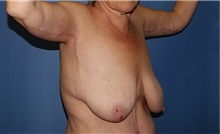 Body Contouring After Photo by Siamak Agha, MD PhD FACS; Newport Beach, CA - Case 44130