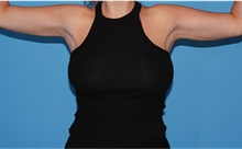 Body Contouring After Photo by Siamak Agha, MD PhD FACS; Newport Beach, CA - Case 44138