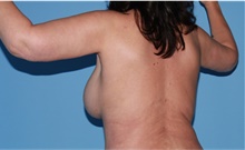 Body Contouring After Photo by Siamak Agha, MD PhD FACS; Newport Beach, CA - Case 44141