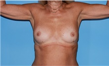 Body Contouring Before Photo by Siamak Agha, MD PhD FACS; Newport Beach, CA - Case 44142