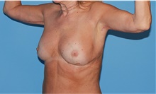 Body Contouring After Photo by Siamak Agha, MD PhD FACS; Newport Beach, CA - Case 44142