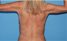 Body Contouring After Photo by Siamak Agha, MD PhD FACS; Newport Beach, CA - Case 44142