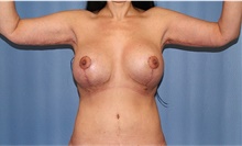 Body Contouring After Photo by Siamak Agha, MD PhD FACS; Newport Beach, CA - Case 44145
