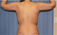 Body Contouring After Photo by Siamak Agha, MD PhD FACS; Newport Beach, CA - Case 44145