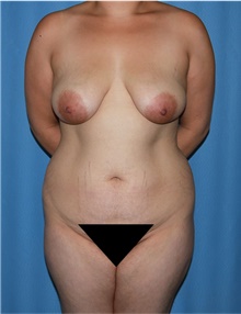 Mommy Makeover Before Photo by Siamak Agha, MD PhD FACS; Newport Beach, CA - Case 44150