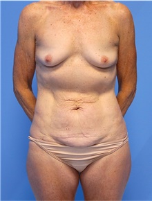 Mommy Makeover Before Photo by Siamak Agha, MD PhD FACS; Newport Beach, CA - Case 44156