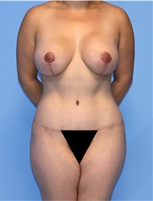 Body Contouring After Photo by Siamak Agha, MD PhD FACS; Newport Beach, CA - Case 44162