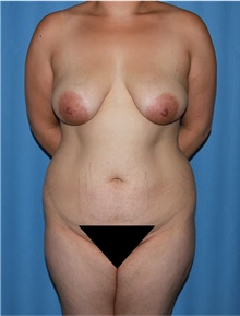 Body Contouring Before Photo by Siamak Agha, MD PhD FACS; Newport Beach, CA - Case 44162
