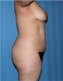 Body Contouring Before Photo by Siamak Agha, MD PhD FACS; Newport Beach, CA - Case 44162
