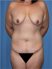 Body Contouring Before Photo by Siamak Agha, MD; Newport Beach, CA - Case 44165