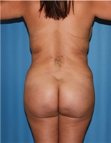 Body Contouring Before Photo by Siamak Agha, MD PhD FACS; Newport Beach, CA - Case 44167