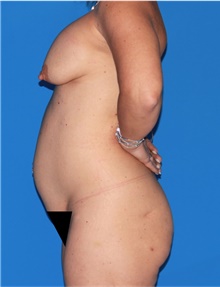 Body Contouring Before Photo by Siamak Agha, MD; Newport Beach, CA - Case 44169