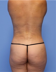Body Contouring After Photo by Siamak Agha, MD; Newport Beach, CA - Case 44169