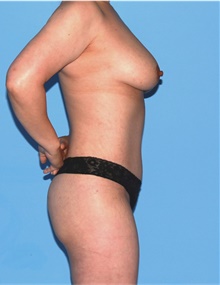 Body Contouring After Photo by Siamak Agha, MD PhD FACS; Newport Beach, CA - Case 44171