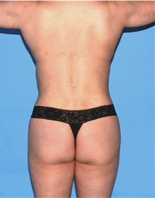 Body Contouring After Photo by Siamak Agha, MD PhD FACS; Newport Beach, CA - Case 44171