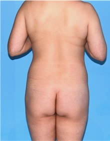 Body Contouring Before Photo by Siamak Agha, MD PhD FACS; Newport Beach, CA - Case 44171