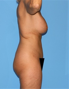 Body Contouring After Photo by Siamak Agha, MD PhD FACS; Newport Beach, CA - Case 44172