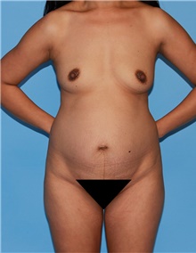 Body Contouring Before Photo by Siamak Agha, MD; Newport Beach, CA - Case 44183