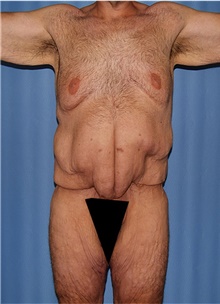 Body Contouring Before Photo by Siamak Agha, MD PhD FACS; Newport Beach, CA - Case 44315