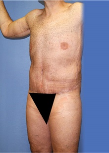 Body Contouring After Photo by Siamak Agha, MD PhD FACS; Newport Beach, CA - Case 44315