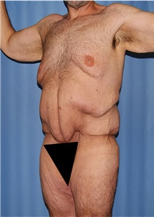 Body Contouring Before Photo by Siamak Agha, MD PhD FACS; Newport Beach, CA - Case 44315