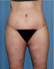 Thigh Lift After Photo by Siamak Agha, MD; Newport Beach, CA - Case 44533