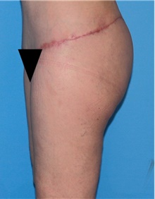 Thigh Lift After Photo by Siamak Agha, MD; Newport Beach, CA - Case 44534