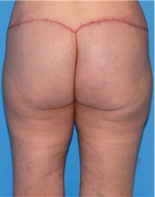 Thigh Lift After Photo by Siamak Agha, MD; Newport Beach, CA - Case 44534