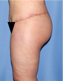 Thigh Lift After Photo by Siamak Agha, MD; Newport Beach, CA - Case 44535