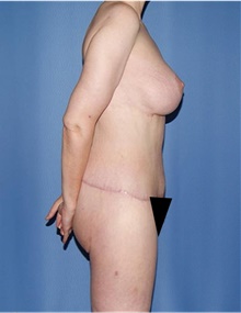 Body Contouring After Photo by Siamak Agha, MD PhD FACS; Newport Beach, CA - Case 44692