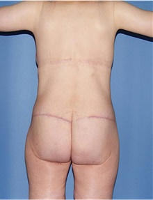 Body Contouring After Photo by Siamak Agha, MD PhD FACS; Newport Beach, CA - Case 44692