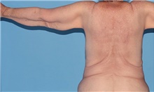 Arm Lift Before Photo by Siamak Agha, MD PhD FACS; Newport Beach, CA - Case 46675