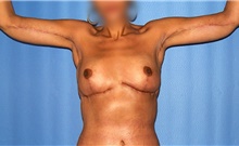Arm Lift After Photo by Siamak Agha, MD; Newport Beach, CA - Case 46677