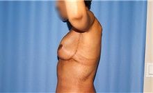 Arm Lift After Photo by Siamak Agha, MD PhD FACS; Newport Beach, CA - Case 46677