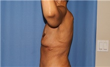Arm Lift Before Photo by Siamak Agha, MD PhD FACS; Newport Beach, CA - Case 46677