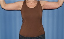 Arm Lift After Photo by Siamak Agha, MD; Newport Beach, CA - Case 46678