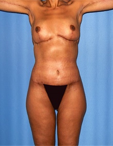 Body Contouring After Photo by Siamak Agha, MD PhD FACS; Newport Beach, CA - Case 46679